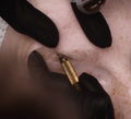 Manual Nanostroking® Needles